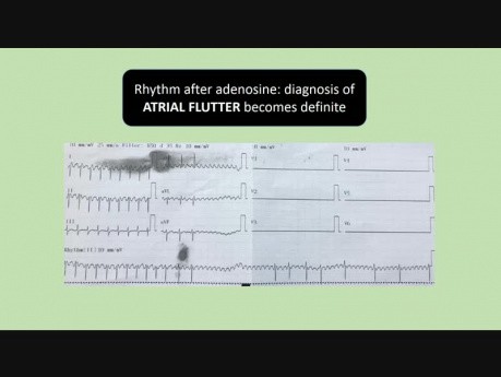 Tachycardia in a 1-day-old Newborn: Atrial Flutter