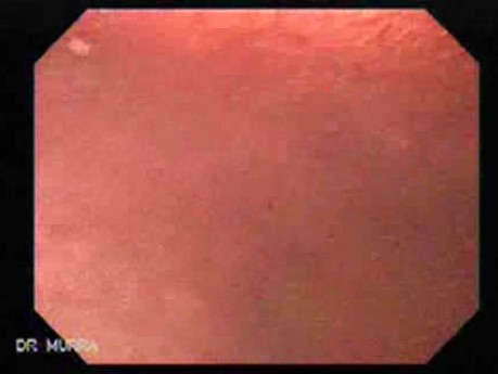 Duodenum - Magnifying Endoscopy