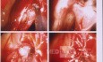 Endoscopic Ligation Of Sphenopalatine Artery 