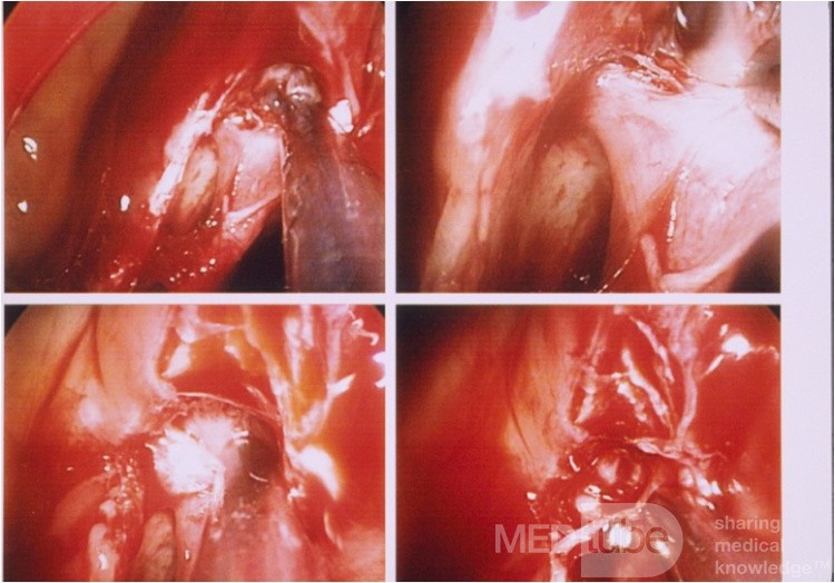 Endoscopic Ligation Of Sphenopalatine Artery 