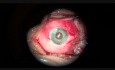 An Artificial Iris Implantation in Both Eyes