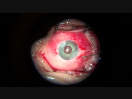 An Artificial Iris Implantation in Both Eyes