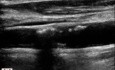The Carotid Artery
