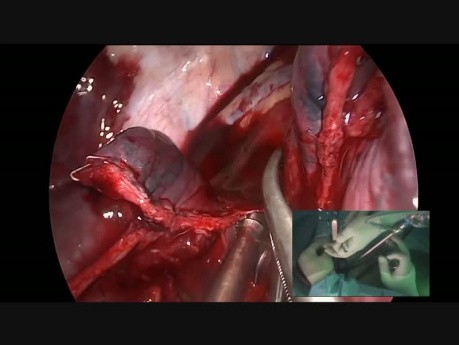 Bleeding Control by Uniportal VATS in a Complex Tumor with Abnormal Artery