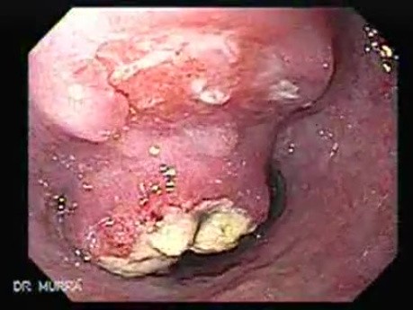 Small cell carcinoma of the lung that invades the upper and the middle third of the Esophagus (2 of 7)