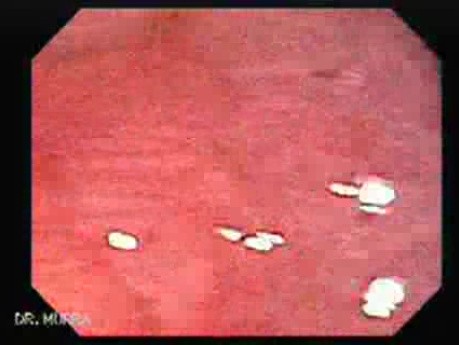 Large Tubulo-Villous Adenoma (2 of 6)