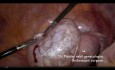 Fertility Sparring Ovarian Cystectomy