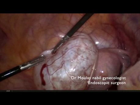 Fertility Sparring Ovarian Cystectomy