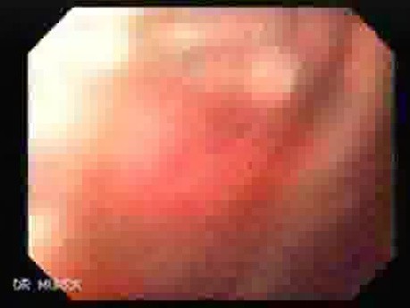Gastric Varices Rosettes Formation (2 of 22)