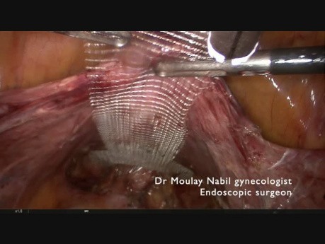 Sacrocolpopexy for Genital Prolapse