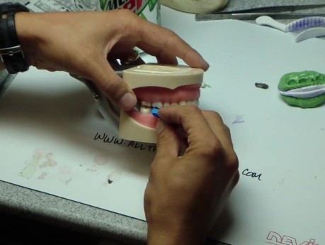 Prep Check For Interocclusal Reduction