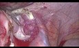 Laparoscopic Hysterectomy