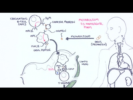 DRESS Syndrome (Drug Related Eosinophilia) - Causes, Pathophysiology, Signs and Symptoms, Treatment