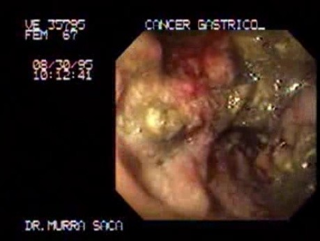 Adenocarcinoma of the Gatsric Body - Obstruction - Endoscopy