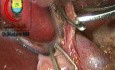 Division of Cystic Artery in the Presence of Caterpillar Hump Should Be Carefully