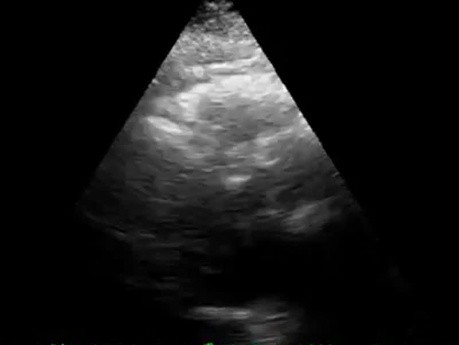 Parasternal long axis. Normal contractile function-atrial fibrillation