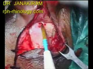 Cochlear Implantation - Part 1 