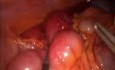 Occlusion Clamp On Laparoscopic 