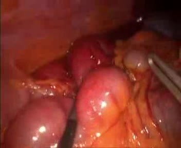 Occlusion Clamp On Laparoscopic 