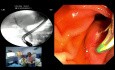 Navigating the Crater: Strategies for Cannulation and Management of the Intradiverticular Papilla