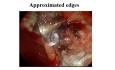 Defect Closure Post ESD / EMR