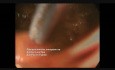 Laparoscopic Ligation of Duct of Luschka