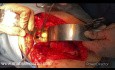 Omentoplasty in Hydatid Liver Cysts