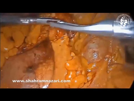 Laparoscopic Right Colectomy for Cecal Cancer