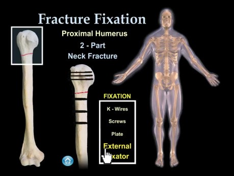 Fracture Fixation & Surgical Techniques - Video Animation