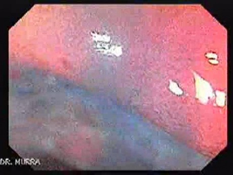 Colonic Tuberculosis Mimicking Crohn's Disease (8 of 12)
