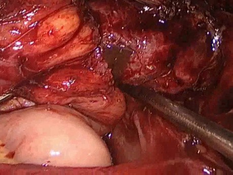 B/L Chocolate Cyst