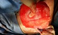 No Pec Touch Breast Reconstruction