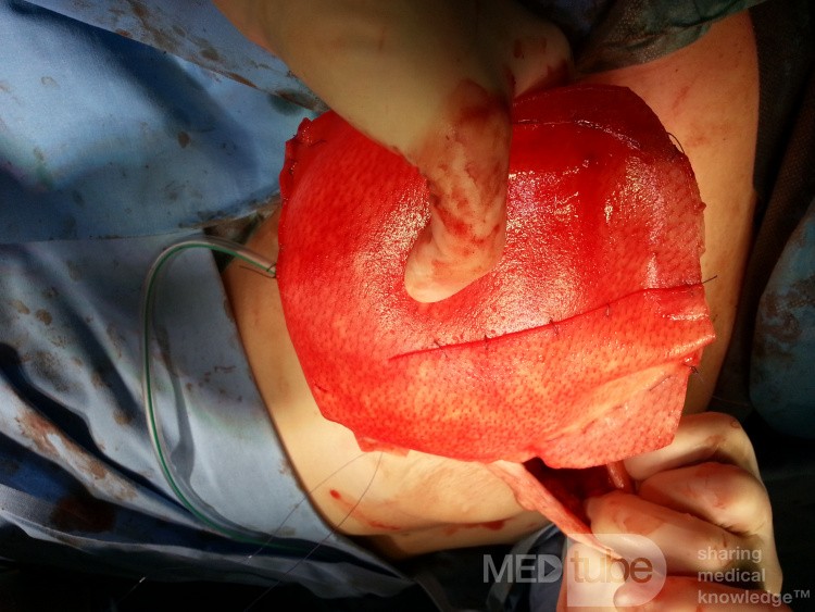 No Pec Touch Breast Reconstruction