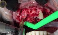 Teeth Extraction with Immediate Implants Placement