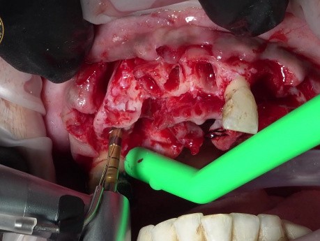 Teeth Extraction with Immediate Implants Placement