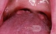 Prominent Circumvallate Papillae