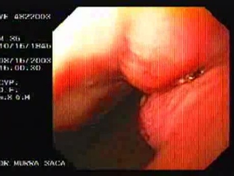 Flexible Endoscopic Suturing - Presence of Knot and Titanum Clip