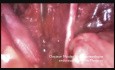 Laparoscopy for Endometrial Cancer in Obese Woman 