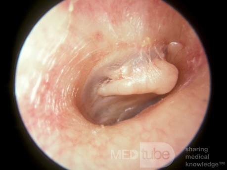 Temporal Bone Fracture [otoscopic appearance]