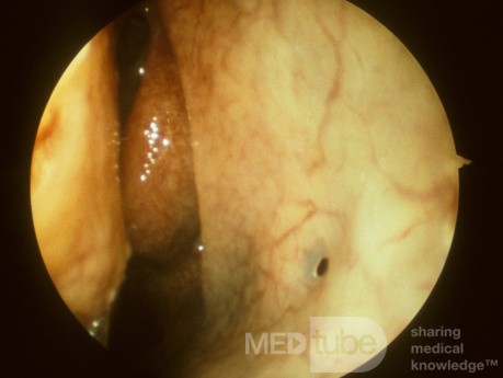 ostium maxillary sinus