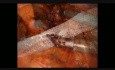 Robotic Hernia Repair Utilizing Robotic Platform