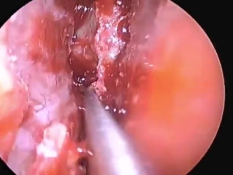 Expanded Endoscopic Trans-septal Approach to the Pituitary