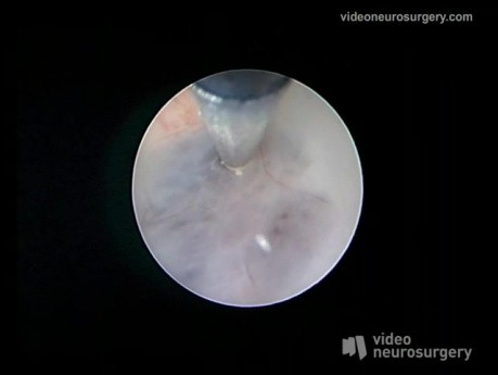 Endoscopic 3Rd Ventriculostomy Surgery - Right Precoronary Approach