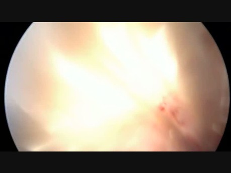 Uniportal VATS Lobectomy and Lymphadenectomy. Live surgery from Bratislava. 