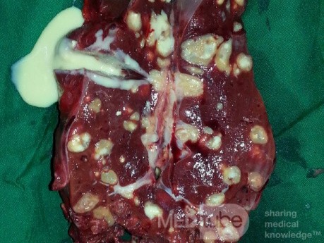 Spleen Tuberculosis 
