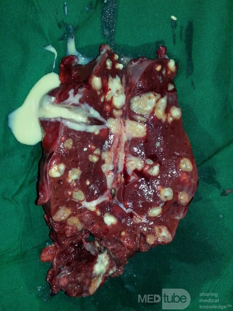 Spleen Tuberculosis 
