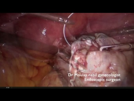 Ideal Dermoid Ovarian Cystectomy for Resident