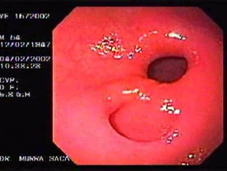 Gastric Antrum Diverticulum
