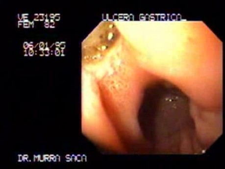 Ulcer of the Antrum