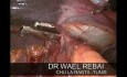 Laparoscopic Truncal Bi-Vagotomy